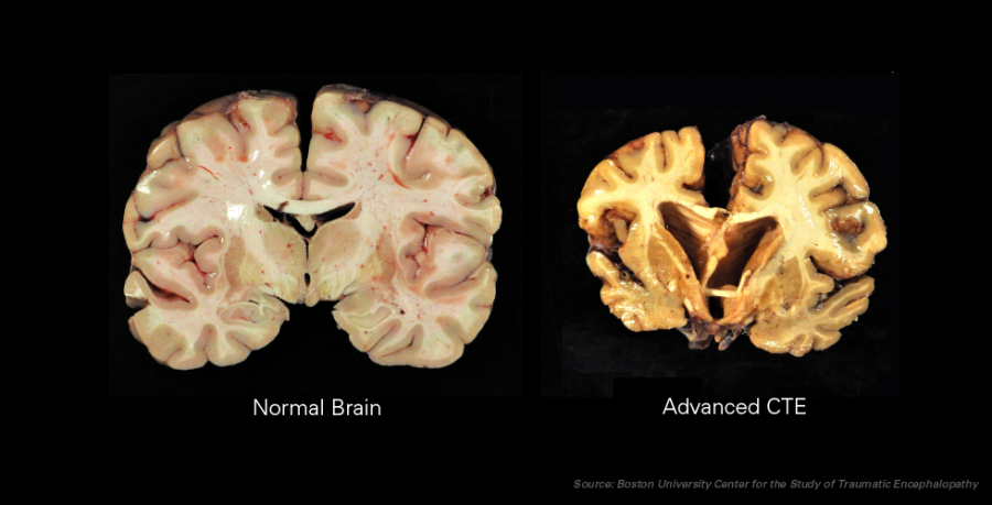 A healthy brain is displayed on the left besides a brain damaged by chronic traumatic encephalopathy on the right. The long term damage of youth contact football is not yet fully understood. Photo credit: Courtesy of the Boston University Center for the Study of Traumatic Encephalopathy